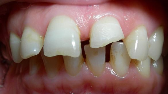 Wisdom Tooth Removal in Nadiad
