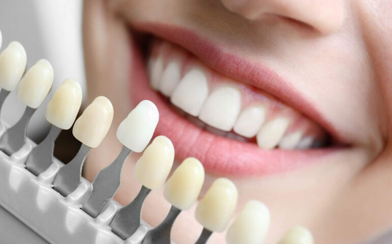 Dental Implants in Nadiad